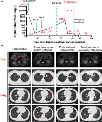 Case report: A case of heterogeneity of the antitumor response to immune checkpoint inhibitors in a patient with relapsed hepatocellular carcinoma